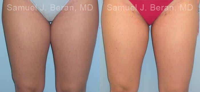 Liposuction Before and After Photos in Newburgh, NY, Patient 12876