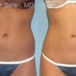 Liposuction Before and After Photos in Newburgh, NY, Patient 12879