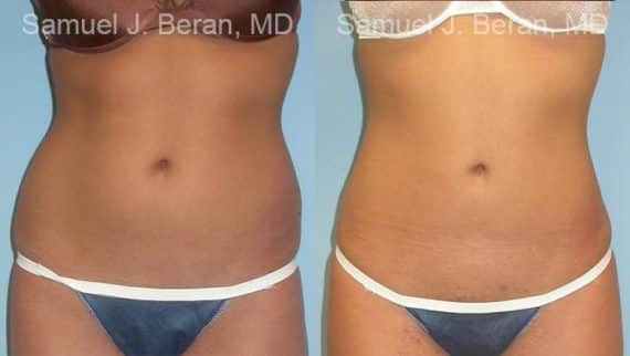 Liposuction Before and After Photos in Newburgh, NY, Patient 12879