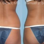 Liposuction Before and After Photos in Newburgh, NY, Patient 12879