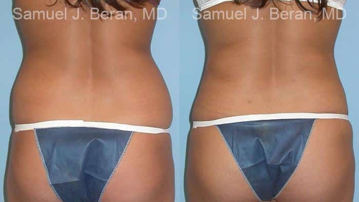 Liposuction Before and After Photos in Newburgh, NY, Patient 12879