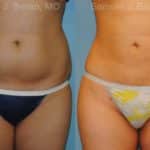 Liposuction Before and After Photos in Newburgh, NY, Patient 12884