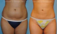 Liposuction Before and After Photos in Newburgh, NY, Patient 12884