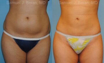 Liposuction Before and After Photos in Montvale, NJ, Patient 12884