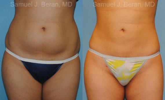 Liposuction Before and After Photos in Newburgh, NY, Patient 12884