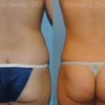 Liposuction Before and After Photos in Newburgh, NY, Patient 12884