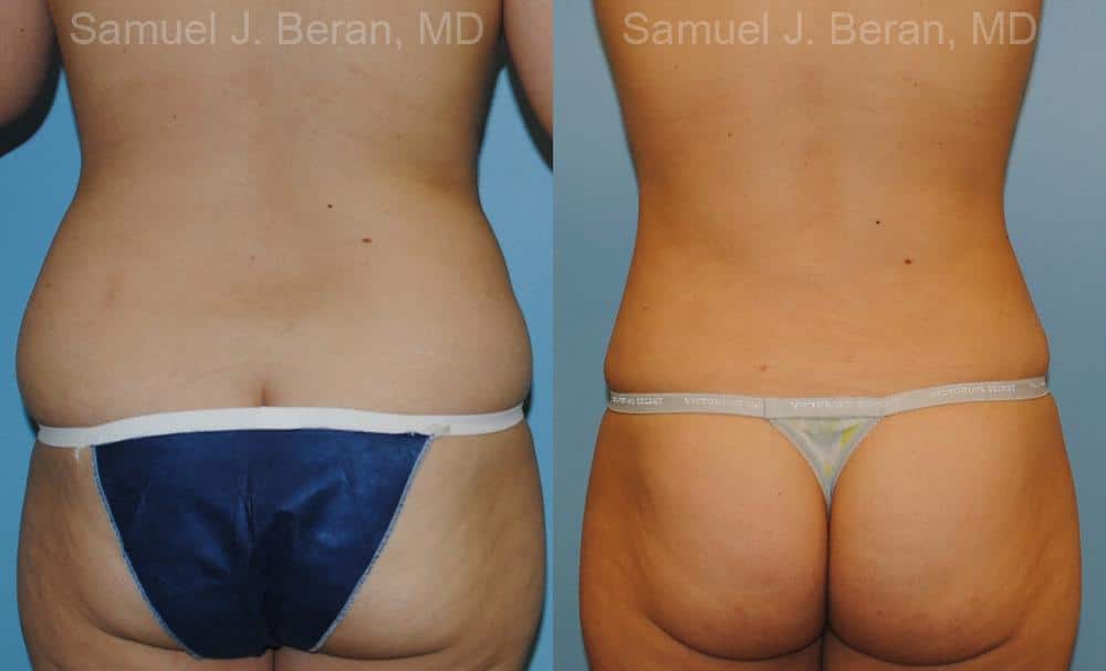 Liposuction Before and After Photos in Newburgh, NY, Patient 12884