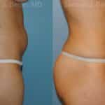 Liposuction Before and After Photos in Newburgh, NY, Patient 12884