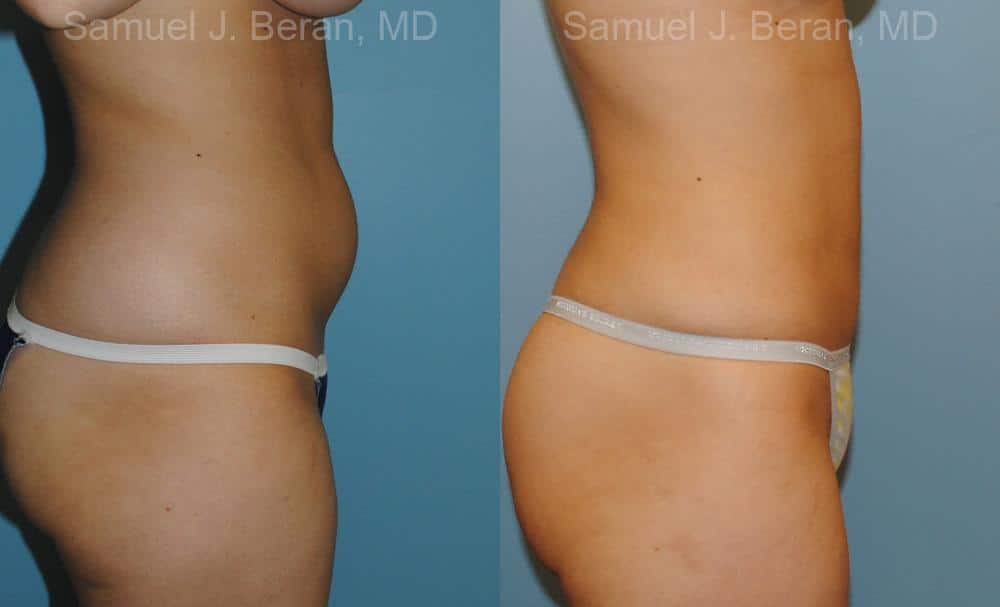 Liposuction Before and After Photos in Newburgh, NY, Patient 12884