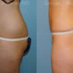 Liposuction Before and After Photos in Newburgh, NY, Patient 12884