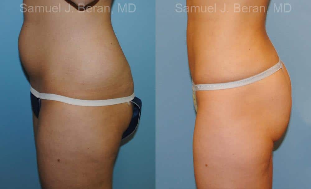 Liposuction Before and After Photos in Newburgh, NY, Patient 12884