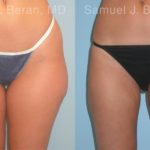 Liposuction Before and After Photos in Newburgh, NY, Patient 12893