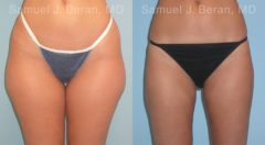 Liposuction Before and After Photos in Newburgh, NY, Patient 12893