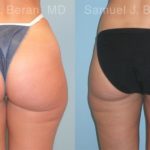 Liposuction Before and After Photos in Newburgh, NY, Patient 12893