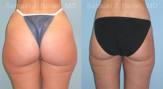 Liposuction Before and After Photos in Newburgh, NY, Patient 12893