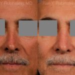 Non-Surgical Rhinoplasty Before and After Photos in Newburgh, NY, Patient 12901