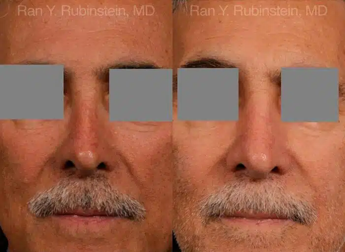 Non-Surgical Rhinoplasty Before and After Photos in Newburgh, NY, Patient 12901