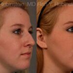 Non-Surgical Rhinoplasty Before and After Photos in Newburgh, NY, Patient 12904