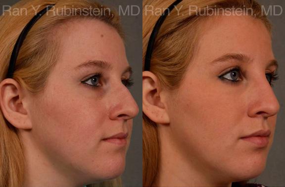 Non-Surgical Rhinoplasty Before and After Photos in Newburgh, NY, Patient 12904