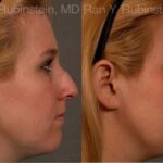 Non-Surgical Rhinoplasty Before and After Photos in Newburgh, NY, Patient 12904