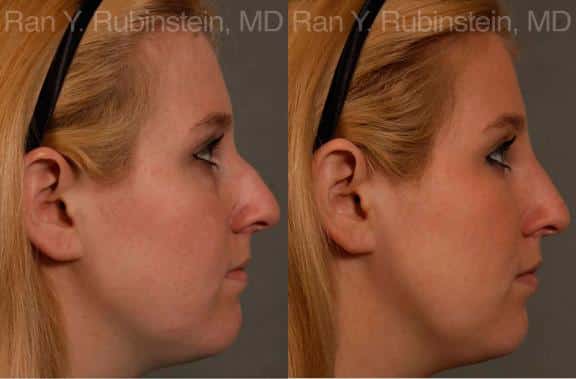 Non-Surgical Rhinoplasty Before and After Photos in Newburgh, NY, Patient 12904