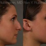 Non-Surgical Rhinoplasty Before and After Photos in Newburgh, NY, Patient 12909