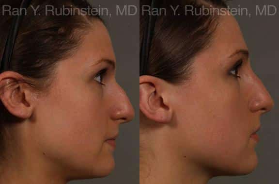 Non-Surgical Rhinoplasty Before and After Photos in Newburgh, NY, Patient 12909