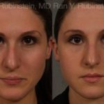 Non-Surgical Rhinoplasty Before and After Photos in Newburgh, NY, Patient 12909