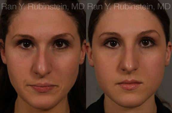 Non-Surgical Rhinoplasty Before and After Photos in Newburgh, NY, Patient 12909