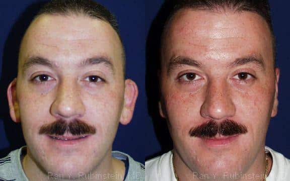 Otoplasty Before and After Photos in Newburgh, NY, Patient 12947