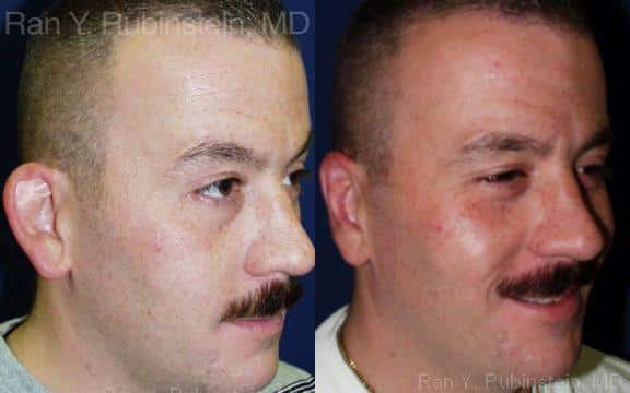 Otoplasty Before and After Photos in Newburgh, NY, Patient 12947