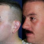 Otoplasty Before and After Photos in Newburgh, NY, Patient 12947