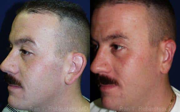 Otoplasty Before and After Photos in Newburgh, NY, Patient 12947