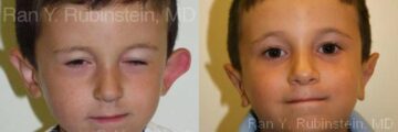 Otoplasty Before and After Photos in Montvale, NJ, Patient 12966