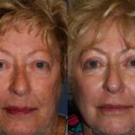 Peels & Microdermabrasion Before and After Photos in Newburgh, NY, Patient 12972