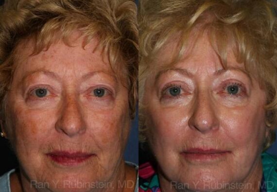 Peels & Microdermabrasion Before and After Photos in Newburgh, NY, Patient 12972