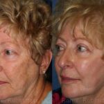 Peels & Microdermabrasion Before and After Photos in Newburgh, NY, Patient 12972