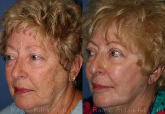 Peels & Microdermabrasion Before and After Photos in Newburgh, NY, Patient 12972