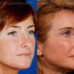 Revision Rhinoplasty Before and After Photos in Newburgh, NY, Patient 12982