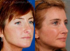 Revision Rhinoplasty Before and After Photos in Newburgh, NY, Patient 12982