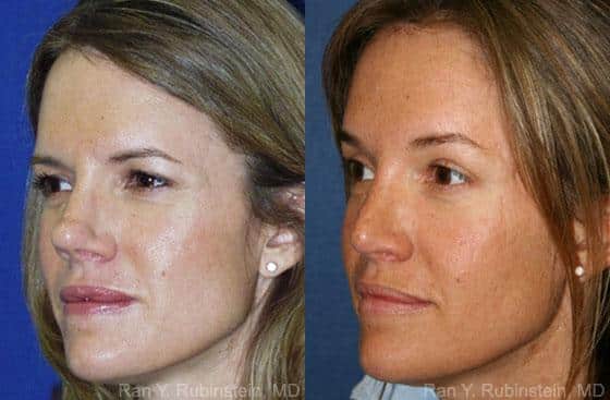 Revision Rhinoplasty by Dr. Ran Rubinstein's in Newburgh, NY.