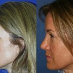 Revision Rhinoplasty Before and After Photos in Newburgh, NY, Patient 12987