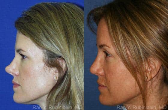 Revision Rhinoplasty Before and After Photos in Newburgh, NY, Patient 12987