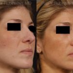 Revision Rhinoplasty Before and After Photos in Newburgh, NY, Patient 12994