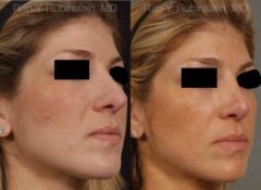 Revision Rhinoplasty Before and After Photos in Newburgh, NY, Patient 12994