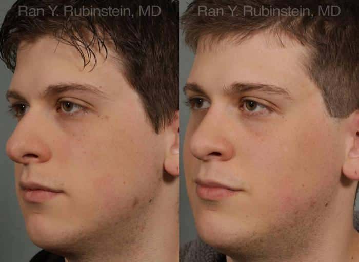 Revision Rhinoplasty Before and After Photos in Newburgh, NY, Patient 12997