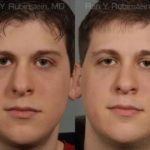 Revision Rhinoplasty Before and After Photos in Newburgh, NY, Patient 12997