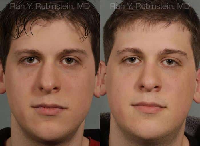 Revision Rhinoplasty Before and After Photos in Newburgh, NY, Patient 12997