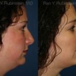 Revision Rhinoplasty Before and After Photos in Newburgh, NY, Patient 13002