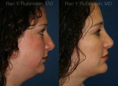 Revision Rhinoplasty Before and After Photos in Newburgh, NY, Patient 13002